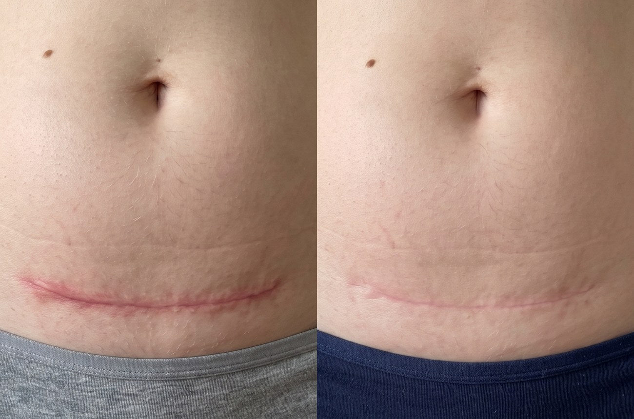 The same C-section scar before and months later: red and raised before, faded and flatter after, still visible
