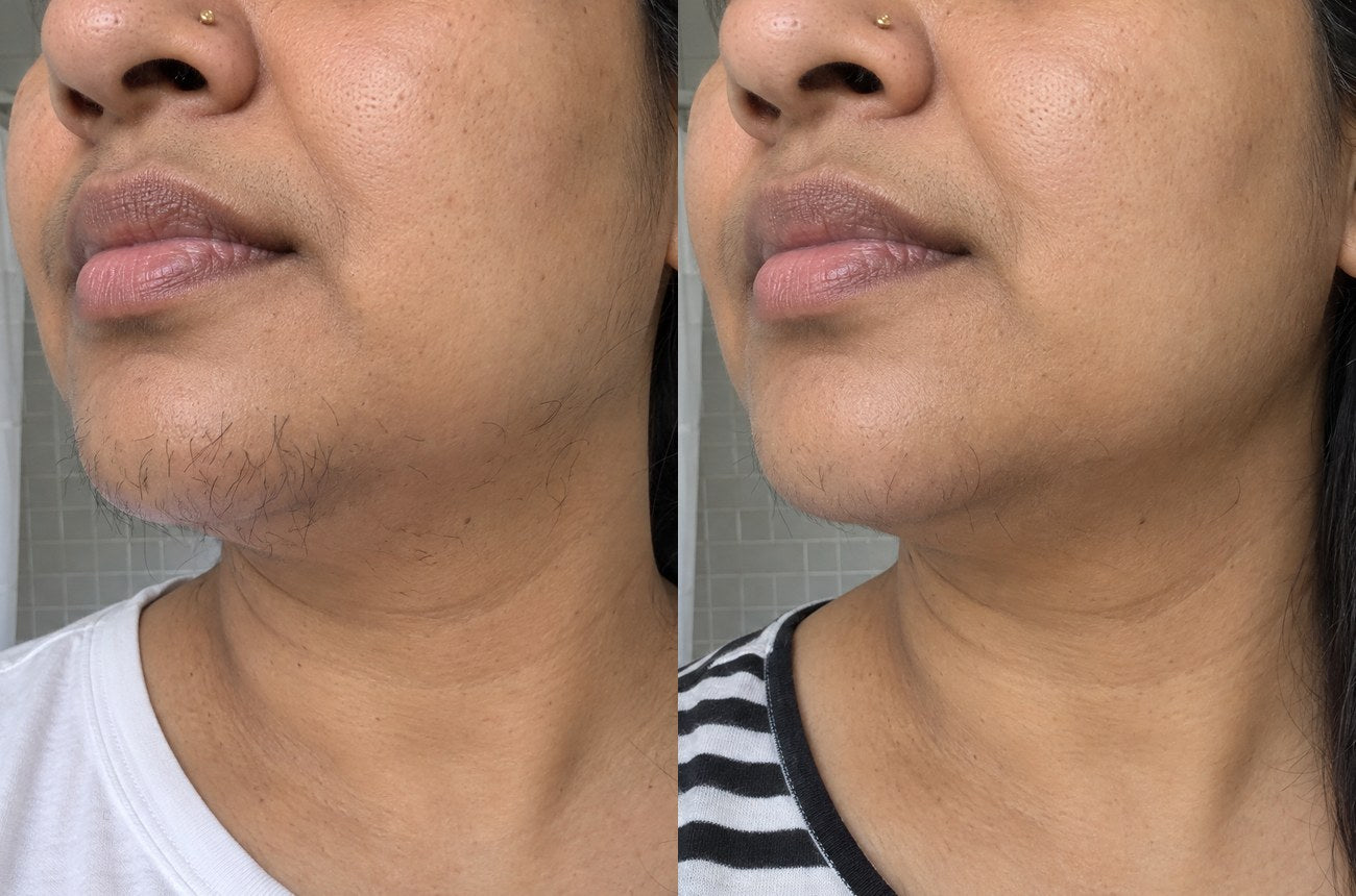 The same chin a few days after shaving: dark stubble before, sparser and finer regrowth months later
